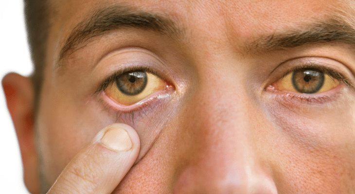 April Newsletter: What Causes Yellow Eyes and How Are They Treated?